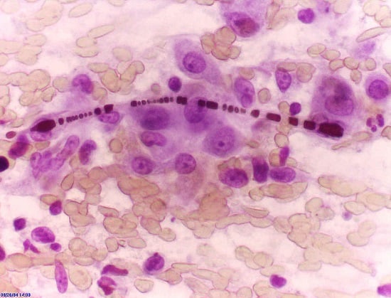 Slide from a lung cancer smear showing asbestos-related lung cancer
